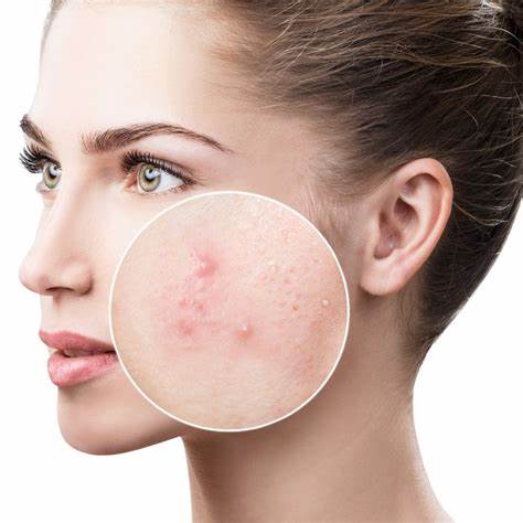 Benefits of our 10 Minute Retinoid Mask for Acne Prone Skin